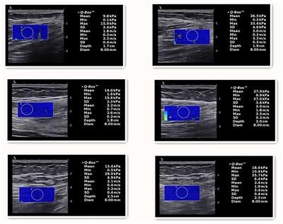 In Hamstring Muscles of Patients With Knee Osteoarthritis an Increased Ultrasound Shear Modulus Indicates a Permanently Elevated Muscle Tonus